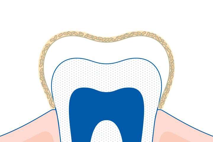Jak powstaje próchnica zębów ?