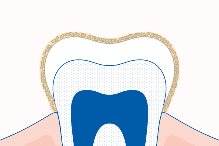 Od czego powstają dziury w zębach ?