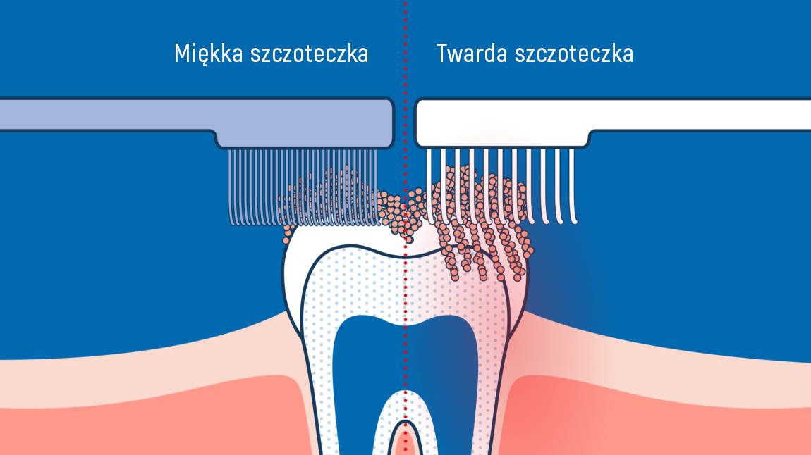 Różnica między czyszczeniem zębów miękką a twardą szczoteczką
